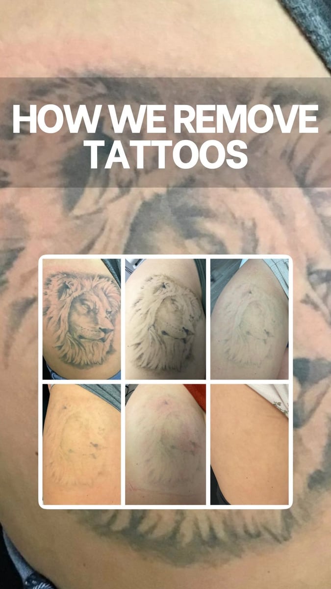 Before and after: Tattoo removal, legs