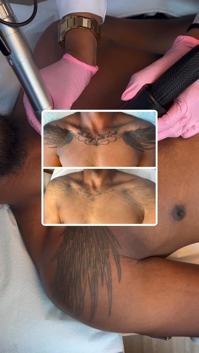 Before and after: Tattoo removal, chest