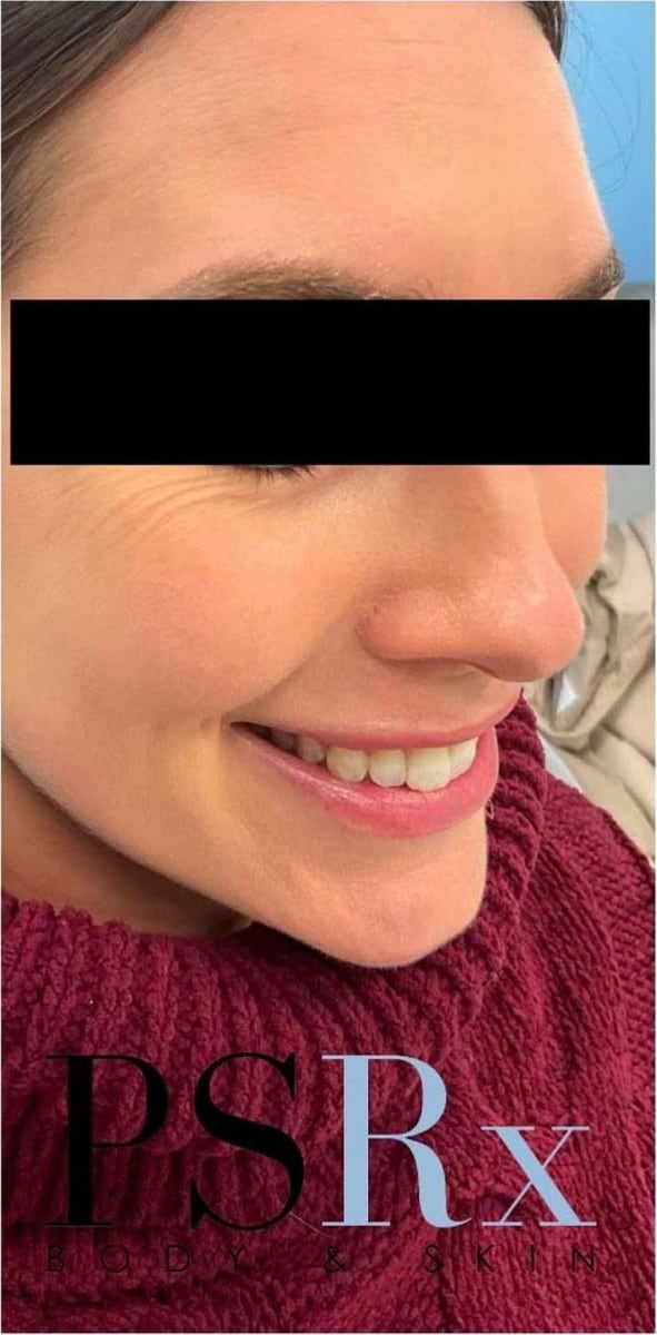 After: Acne, face