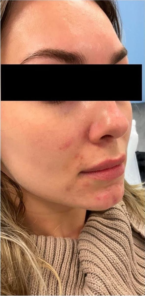 Before: Acne, face