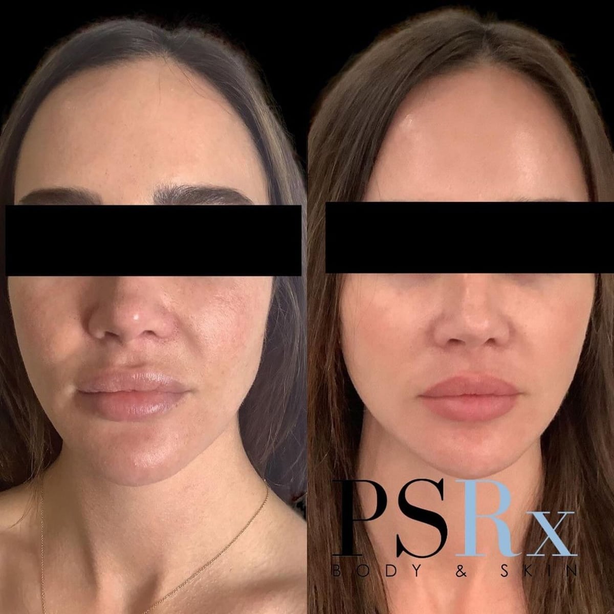 Before and after: Sculptra, face
