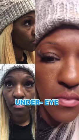 Before and after: Filler, under the eyes