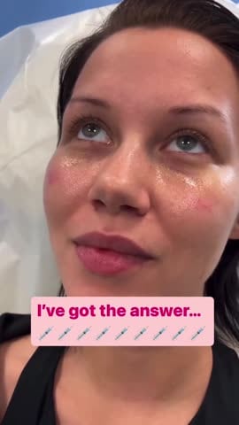 After: Filler, under the eyes