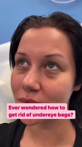 Before: Filler, under the eyes