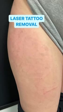 After: Tattoo removal, legs