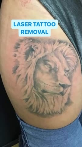 Before: Tattoo removal, legs