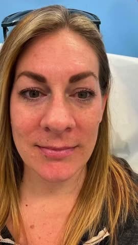 After: Filler, under the eyes