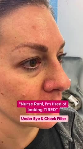 Before: Filler, under the eyes