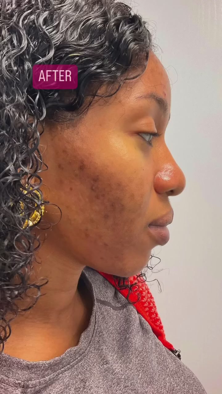 After: Dark marks after breakouts