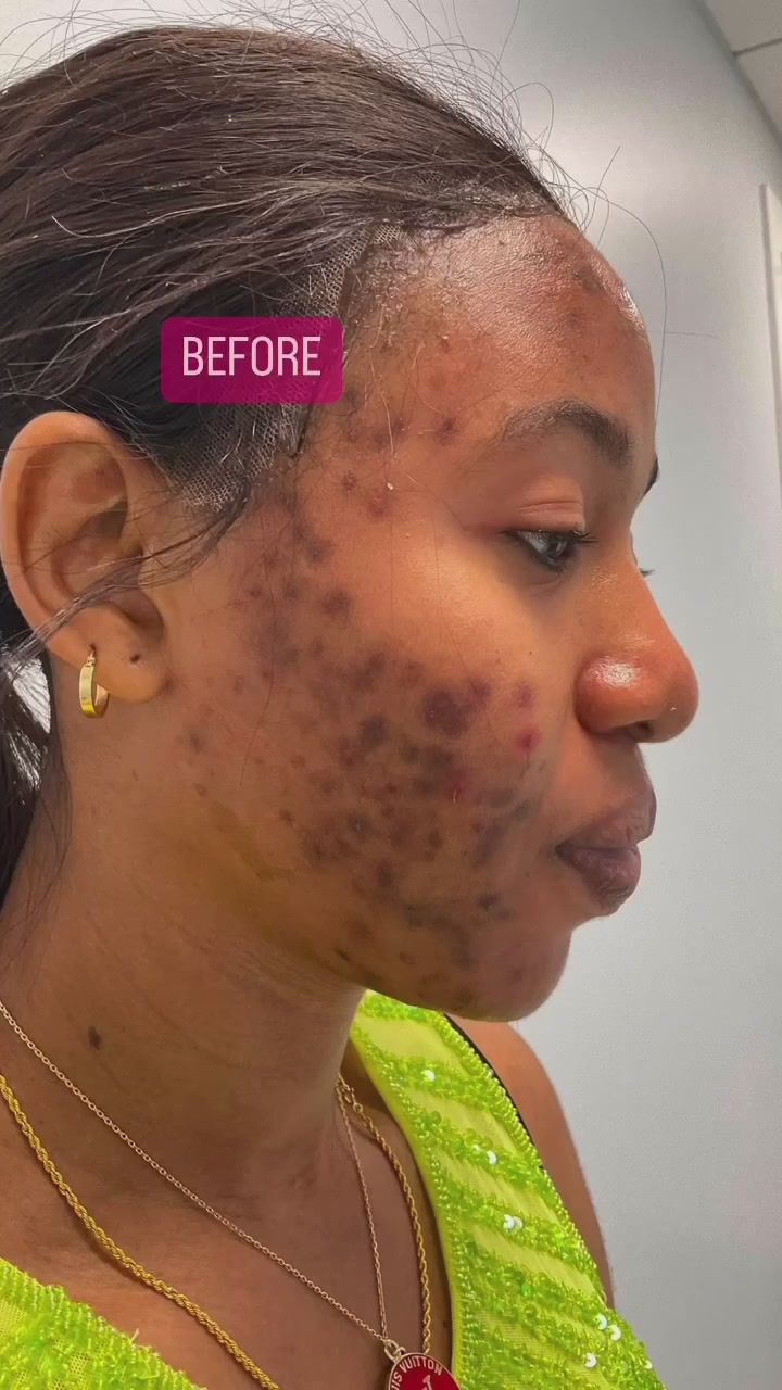 Before: Dark marks after breakouts