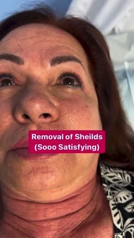 Before and after: Tattoo removal, face