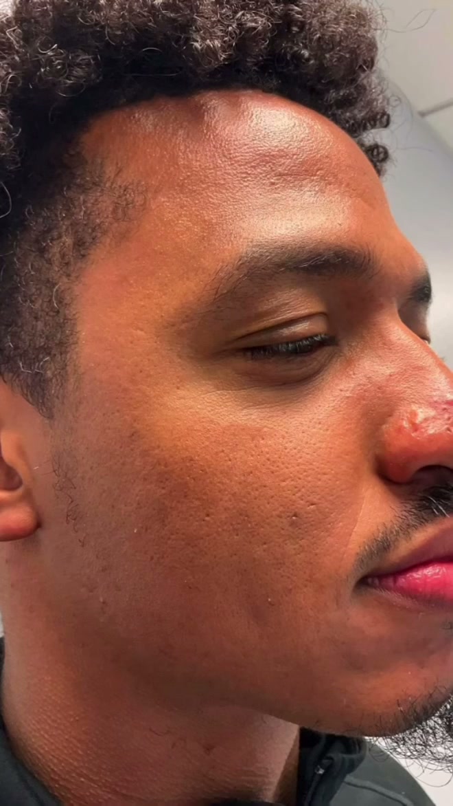 After: Breakout marks on the cheek