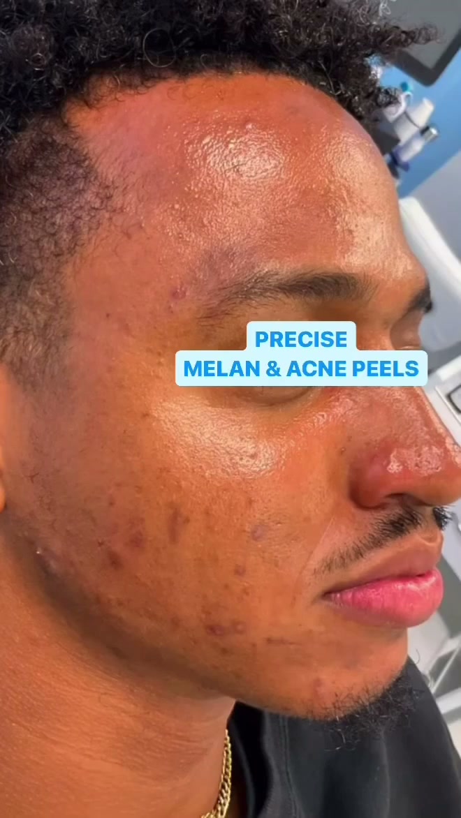 Before: Breakout marks on the cheek