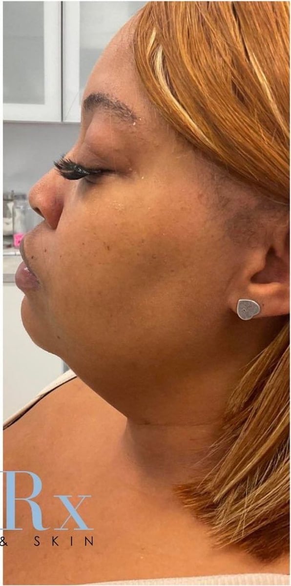 After: Kybella, chin and jaw