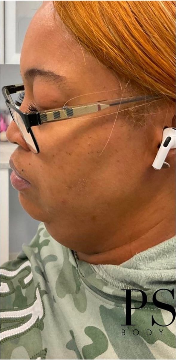 Before: Kybella, chin and jaw