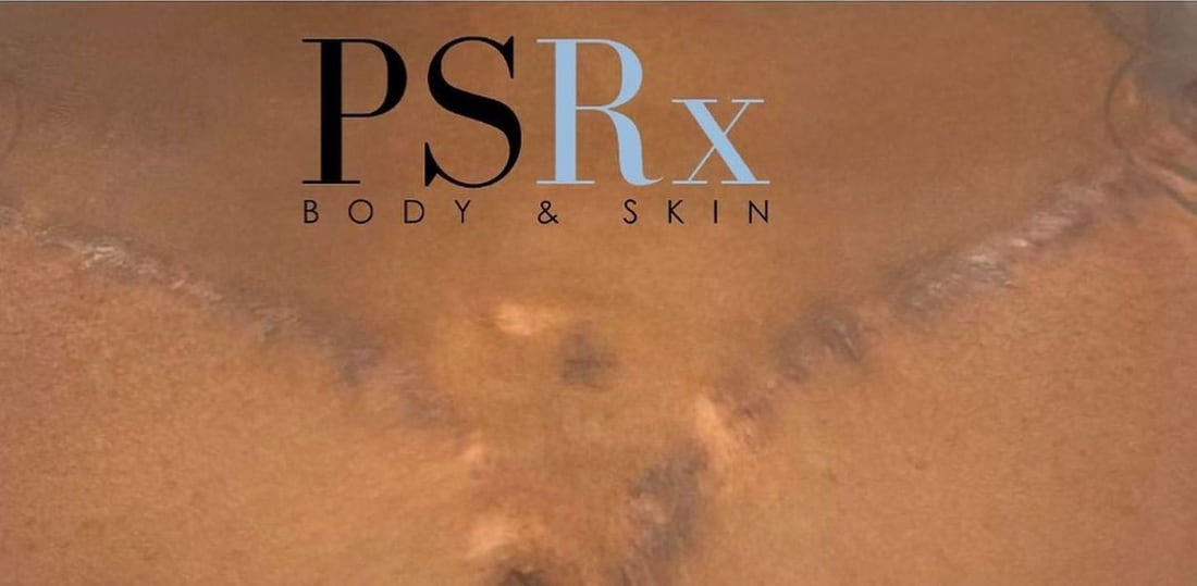 After: Chest keloids