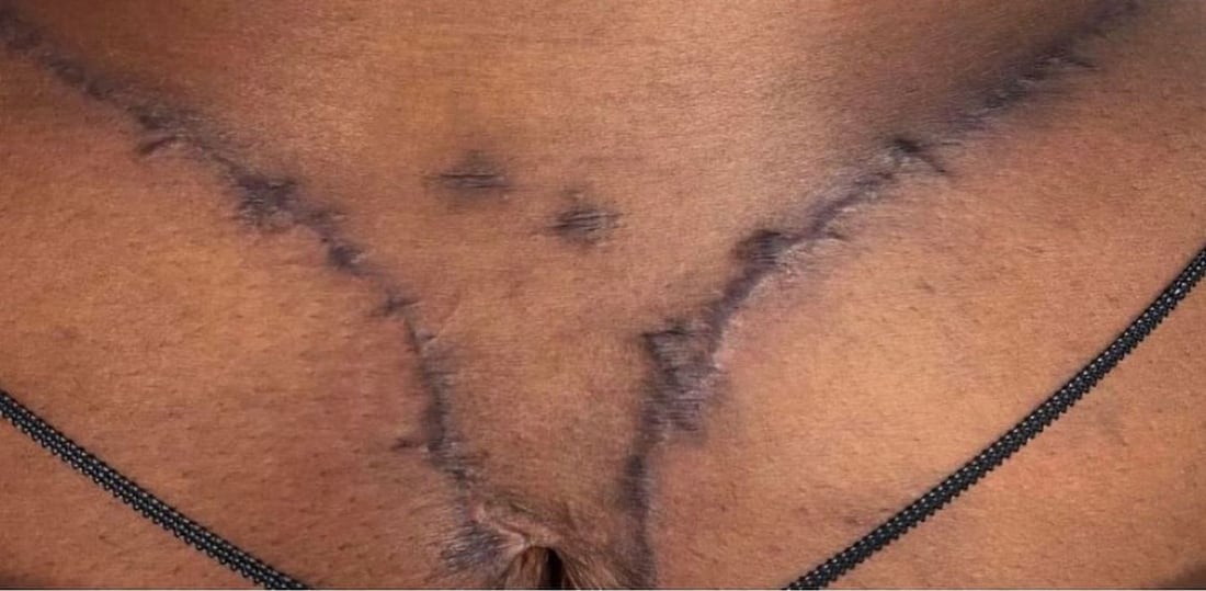 Before: Chest keloids