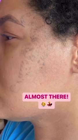 After: Tattoo removal, face