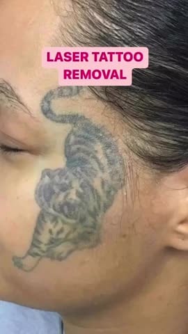 Before: Tattoo removal, face