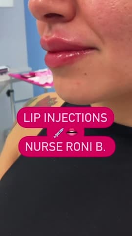 After: Filler, lips