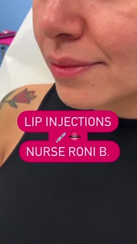 Before: Filler, lips