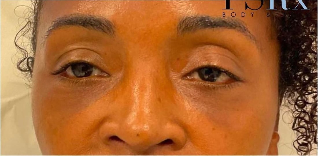 After: Under-eye hollows