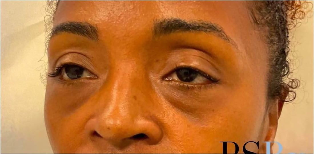 Before: Under-eye hollows