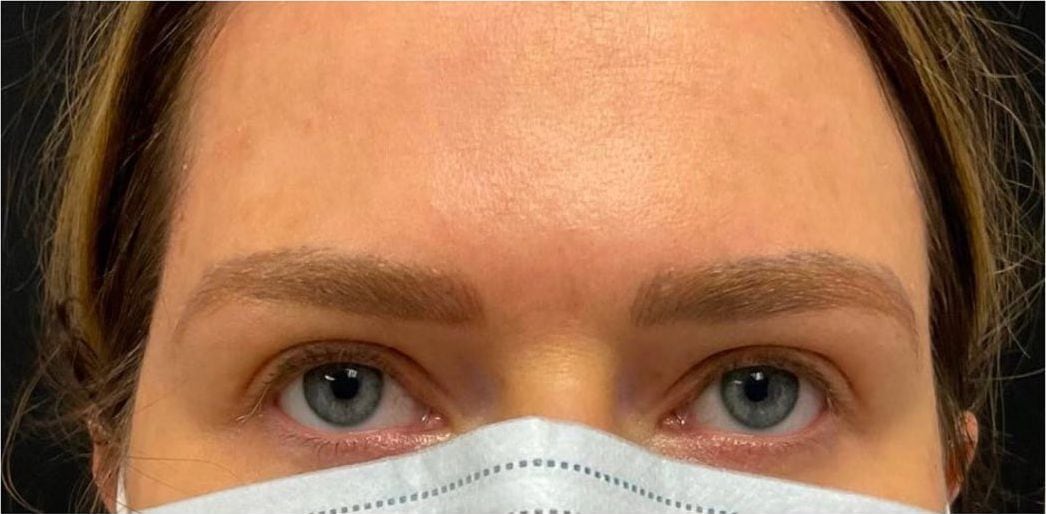 Before: Tattoo removal, brows