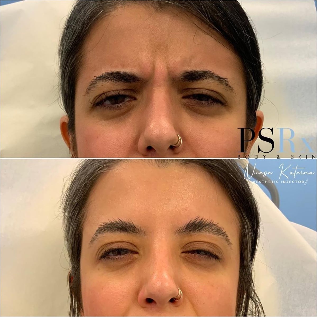 Before and after: Neurotoxin, forehead