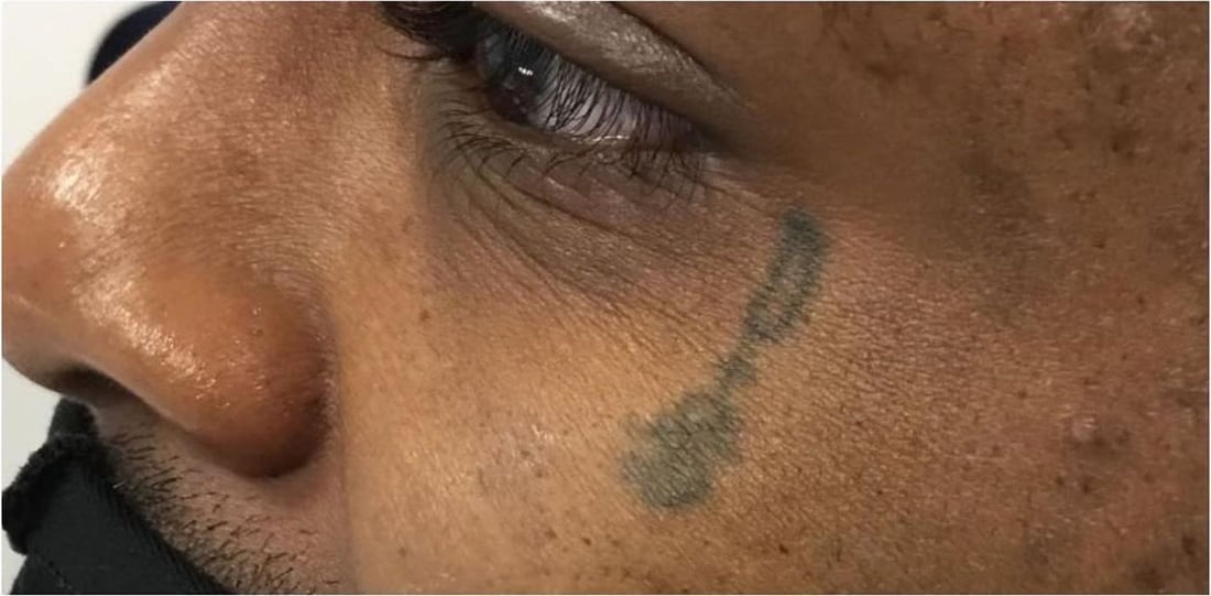Before: A face tattoo, gone