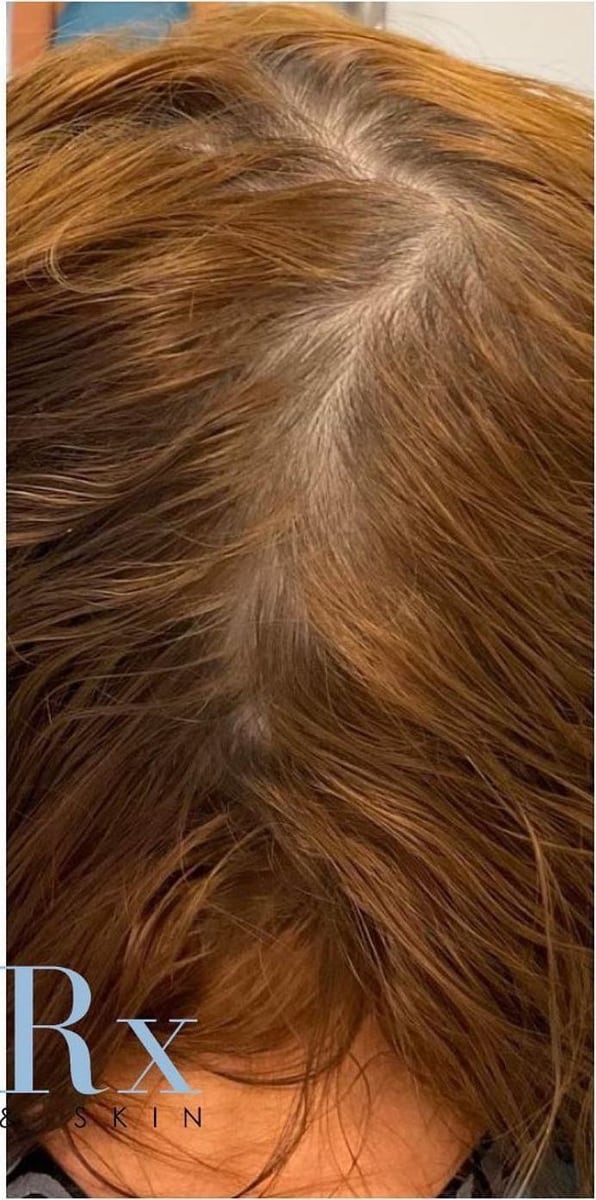 After: PRP hair restoration, scalp