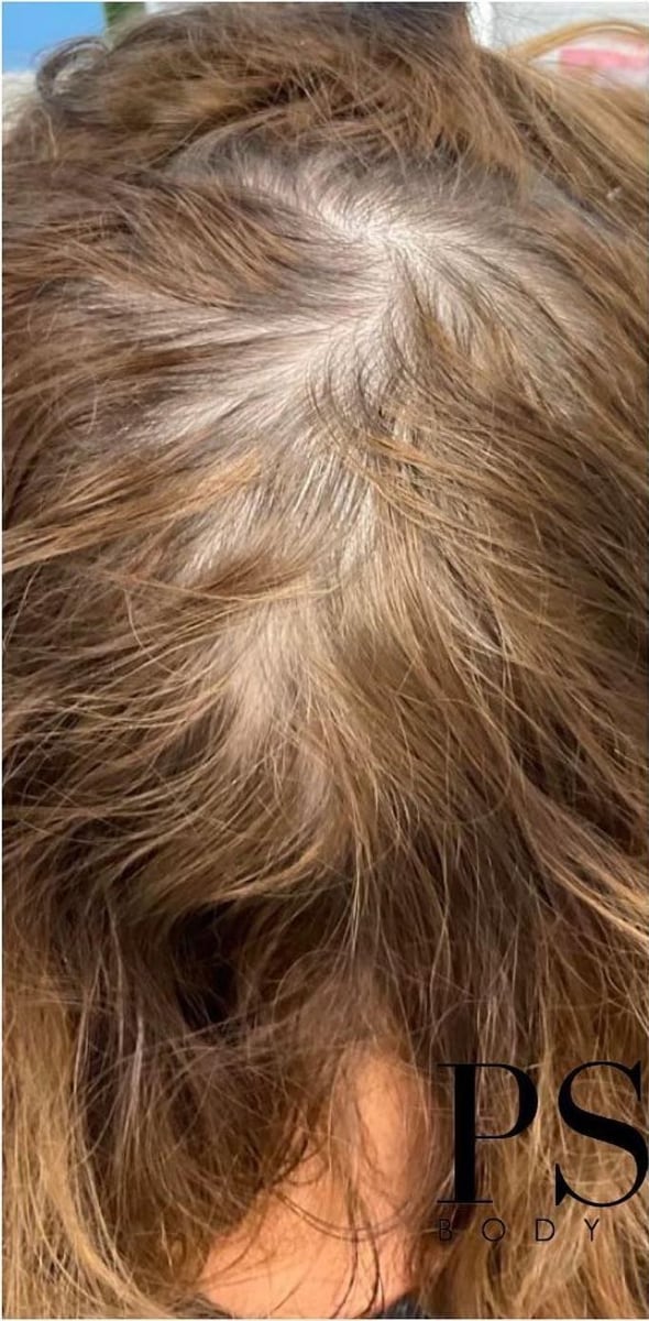 Before: PRP hair restoration, scalp