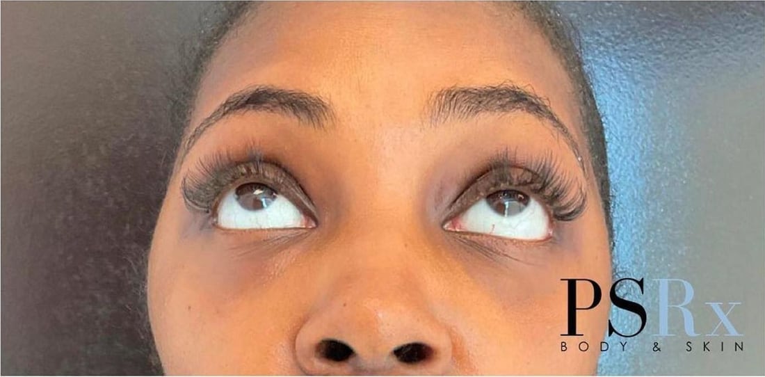 After: Under-eye hollowing
