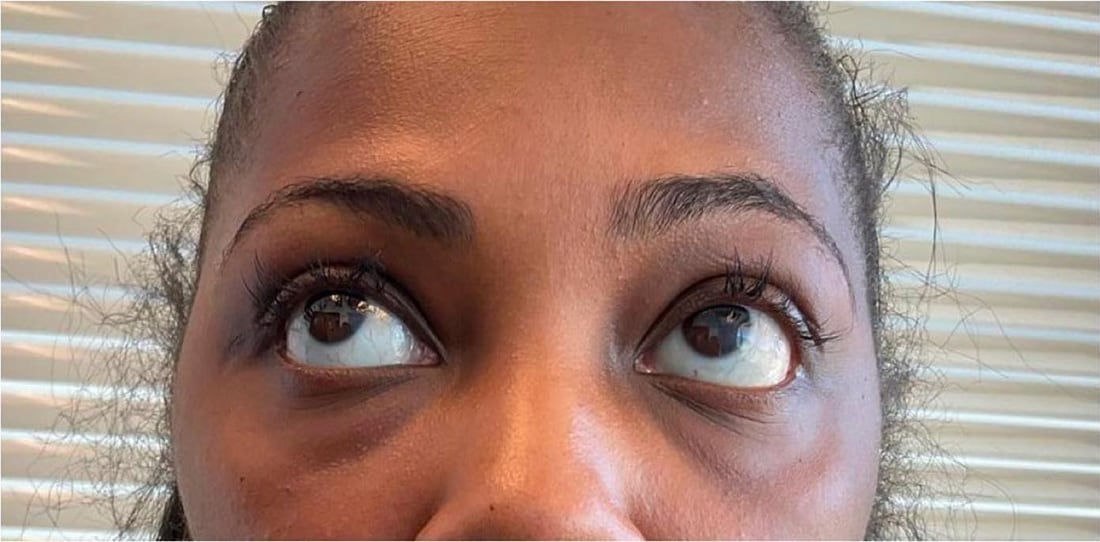Before: Under-eye hollowing