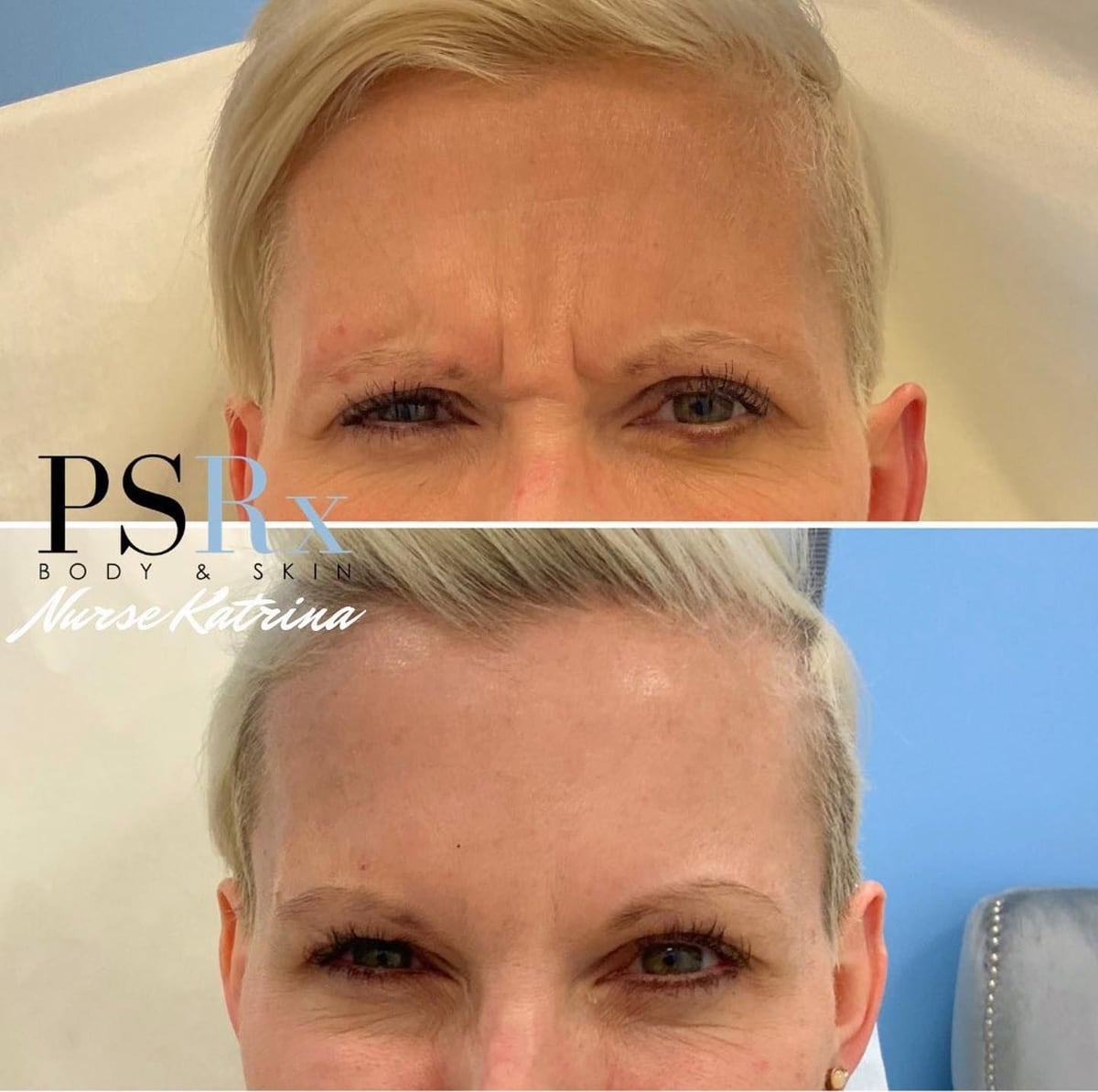 Before and after: Neurotoxin, forehead