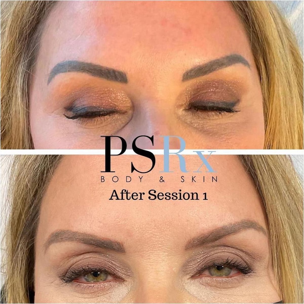 Before and after: Tattoo removal, brows