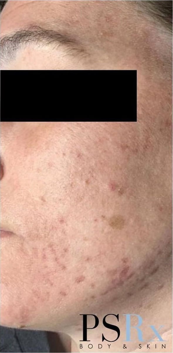 After: Acne, cheeks