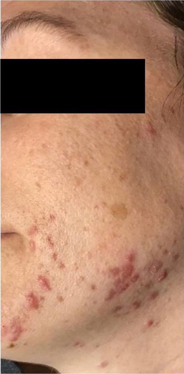 Before: Acne, cheeks