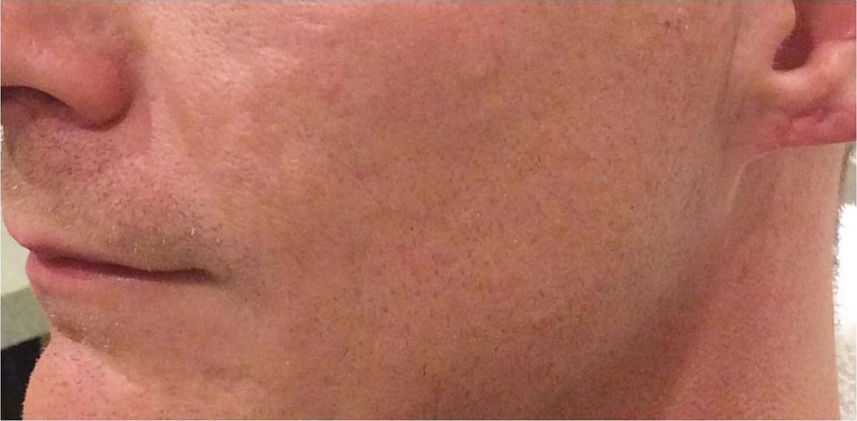 After: Scars, chin and jaw
