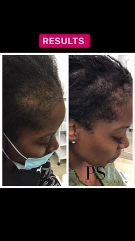 Before and after: PRP hair restoration, scalp