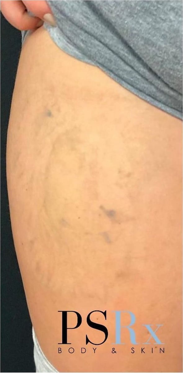 After: Tattoo removal, legs