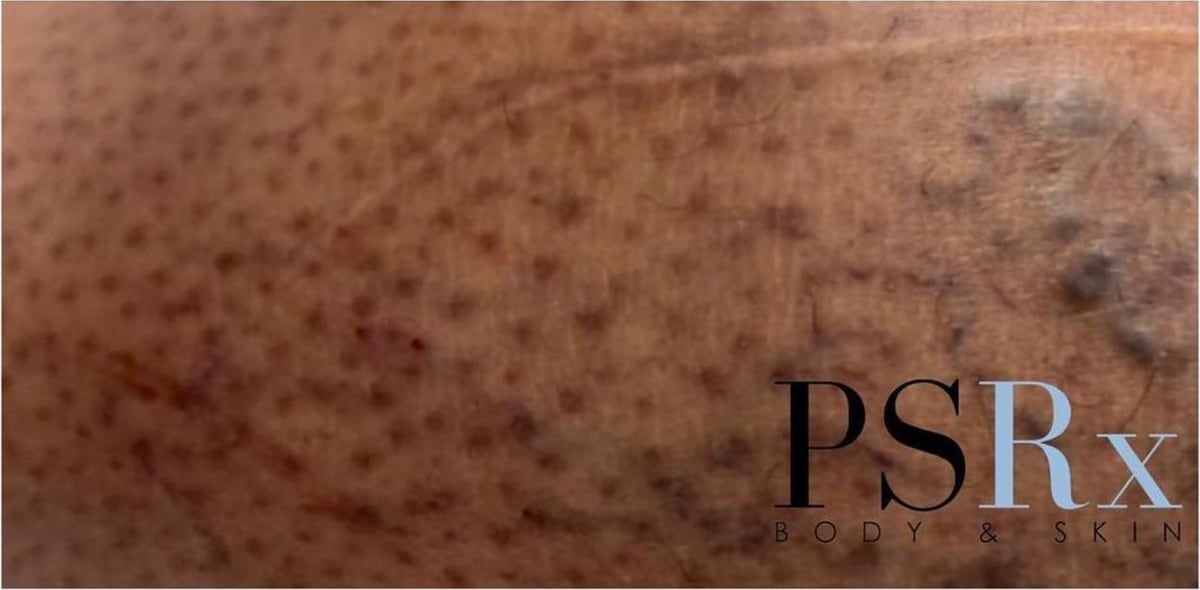 After: Sclerotherapy, legs
