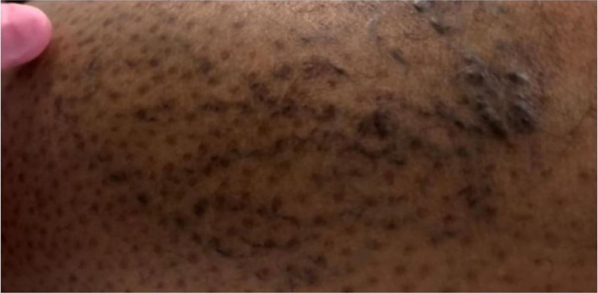 Before: Sclerotherapy, legs