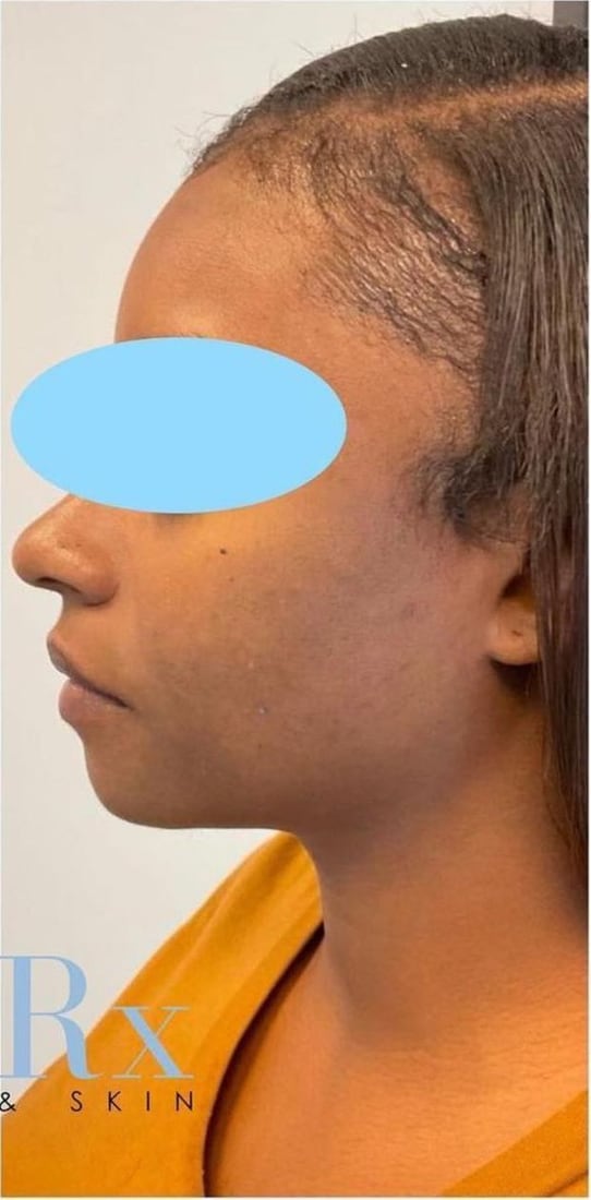 After: Dark marks along the cheek and jaw