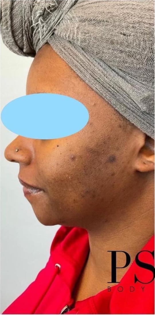 Before: Dark marks along the cheek and jaw