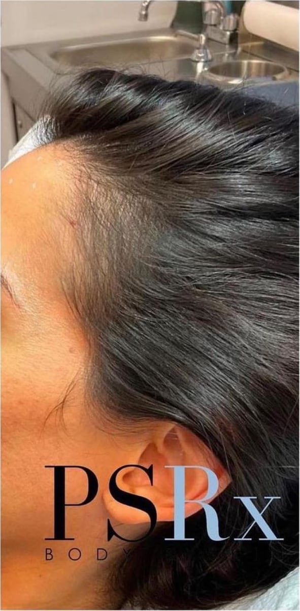 After: PRP hair restoration, scalp