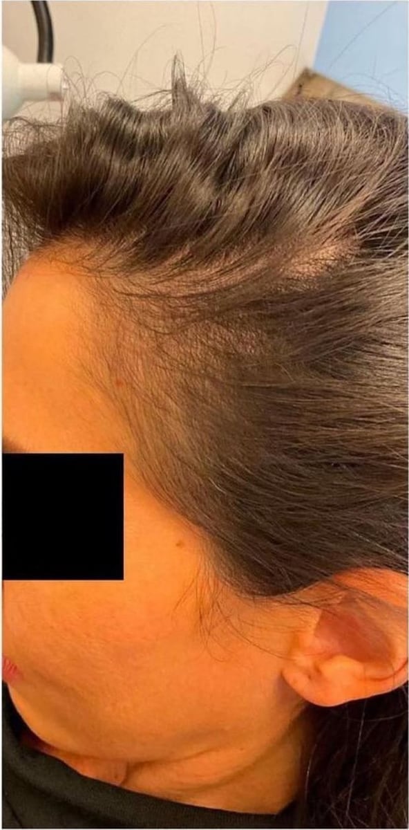 Before: PRP hair restoration, scalp
