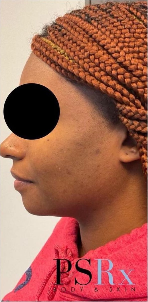 After: Dark spots, face