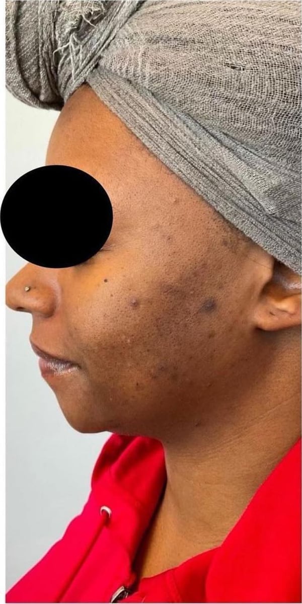 Before: Dark spots, face