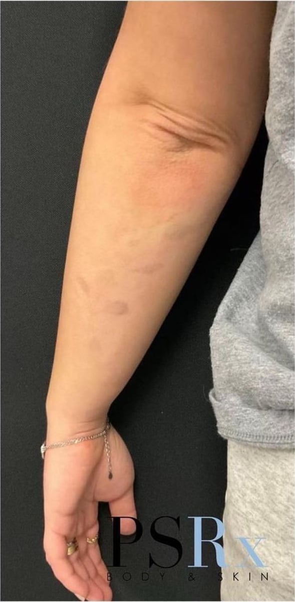 After: Tattoo removal, arm